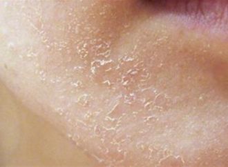 عادات وأمراض مرتبطة بجفاف الجلد