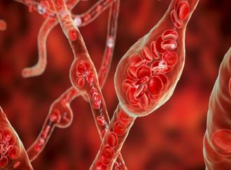 اكتشاف سبب محتمل جديد لارتفاع ضغط الدم وطريقة لعلاجه