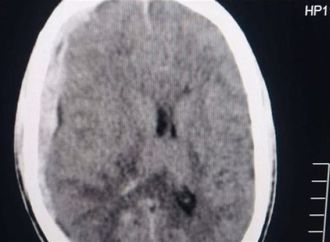 إنقاذ حياة شاب أصيب في رأسه بألة حادة في دمياط