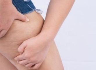 السيلوليت مع التقدم فى العمر.. لماذا يظهر وكيف يمكن تحسين مظهره؟