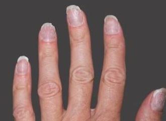علامات صامتة على أظافرك قد تكشف أمراضًا كامنة.. متى يجب زيارة الطبيب؟