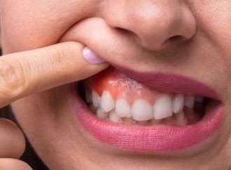علامات تظهر على الفم تدل على التوتر وسوء التغذية