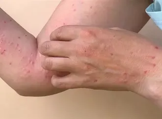 "الصحة العالمية" تعلن اكتشاف متحور يجمع سلالتين لجدري القرود