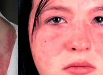 مرض غامض يضرب النساء أكثر.. كل ما تريد معرفته عن الذئبة الحمراء