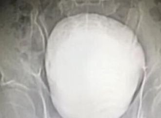 جراحة نادرة تنهى معاناة مزارع صينى مع حصوة ضخمة فى المثانة