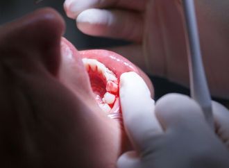 علاقة مقلقة بين نزيف اللثة وتدهور وظائف الكلى