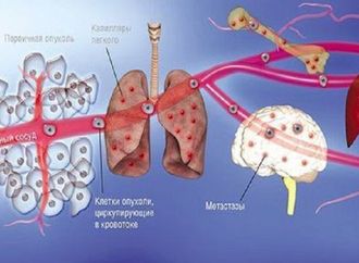 روسيا.. ابتكار نموذج رياضي يتنبأ بمستقبل انتشار الخلايا السرطانية
