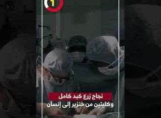 نجاح زرع كبد كامل وكليتين من خنزير إلى إنسان