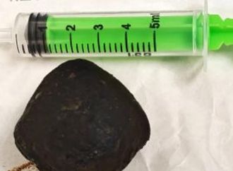 إنقاذ سيدة تعانى من انسداد معوى كامل بسبب حصوة مرارية بمركز الكبد في كفر الشيخ